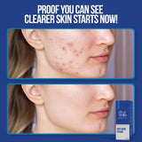 Wiki Special Anti Acne Serum – 30ml | Clears Acne, Soothes Skin & Fights Blemishes