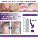 Timilk Regenscar Stem Cell Scar Gel 20g Triple Action Formula For Old And New Scars Surgical Marks Skin Renewal